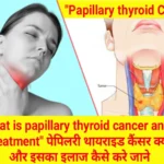 papillary-thyroid-cancer.webp