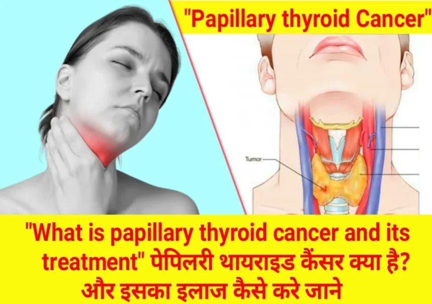 papillary-thyroid-cancer.webp